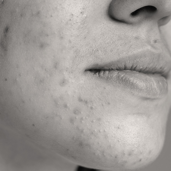 ACNE-PRONE SKIN