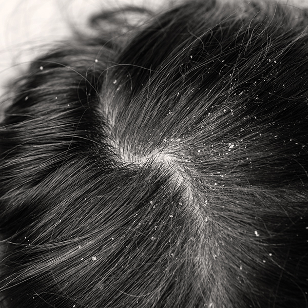 DANDRUFF